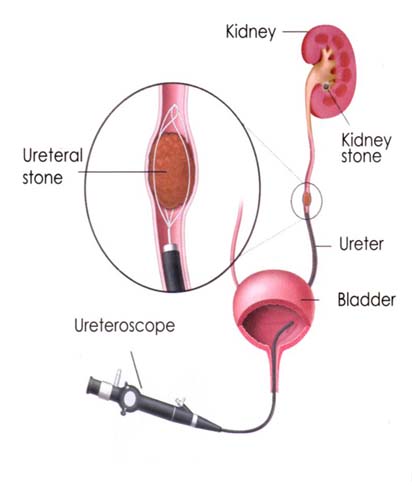 Urinary Tract Infection Treatment Doctors